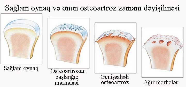 Osteoartroz