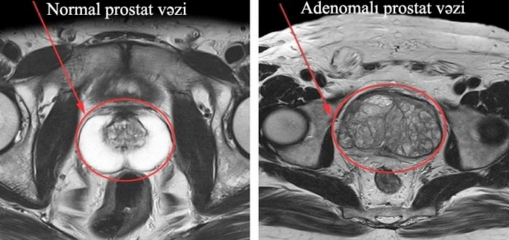 Prostat vəzinin adenoması
