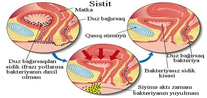 Sistit, sidik kisəsinin selikli qişasının iltihabı